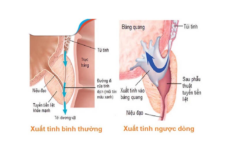 XUẤT TINH NGƯỢC DÒNG Ở NAM GIỚI